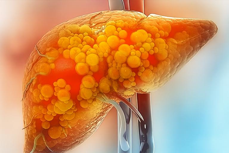 مصنوعی مٹھاس سوربٹول سے جگر کو خطرناک نقصان