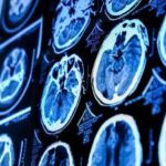 دماغی نکاسی کے راستے الزائمر کی ابتدائی علامت قرار