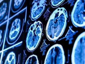 دماغی نکاسی کے راستے الزائمر کی ابتدائی علامت قرار